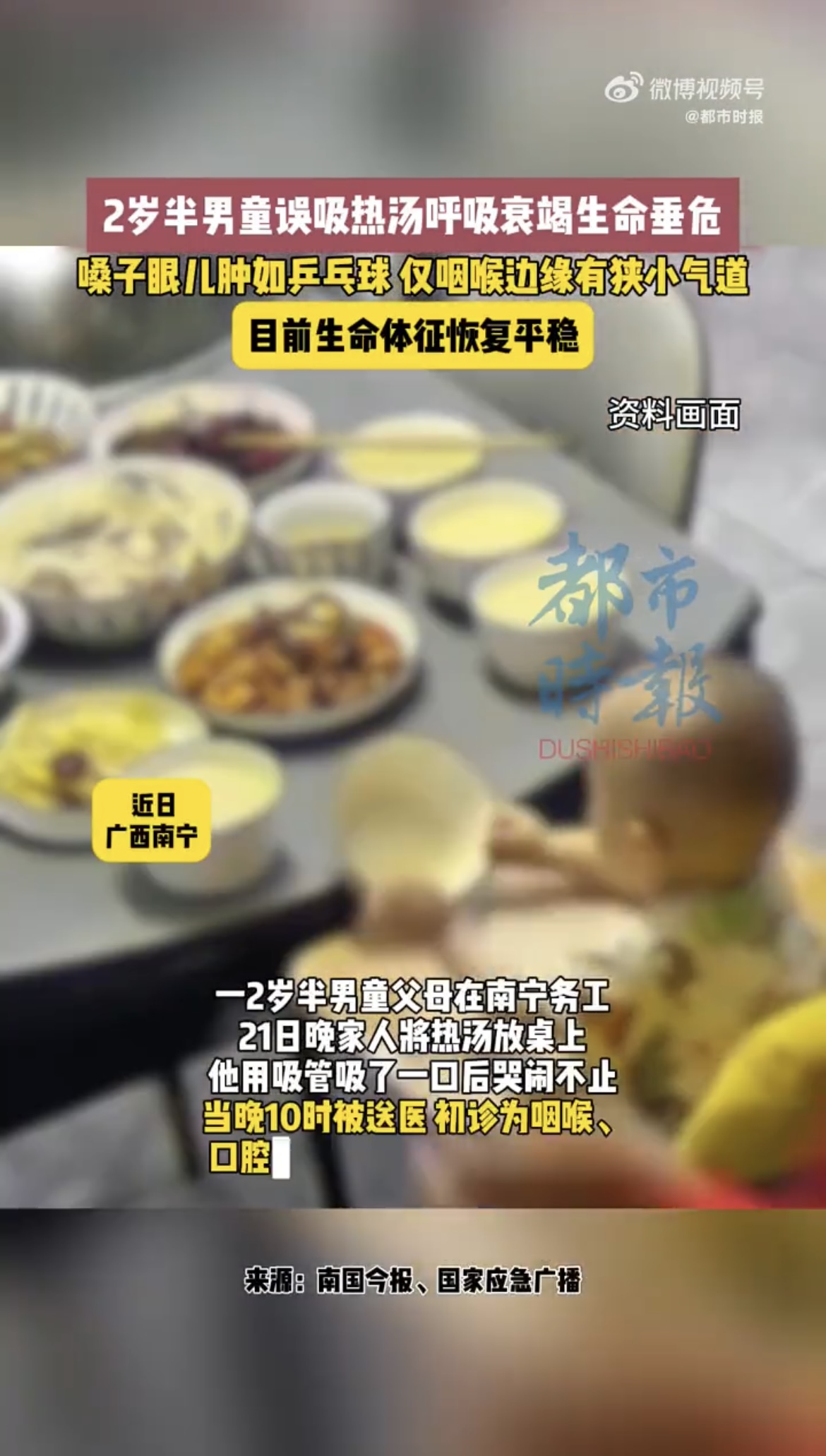 2岁男童因一口热汤住进ICU 1.jpg