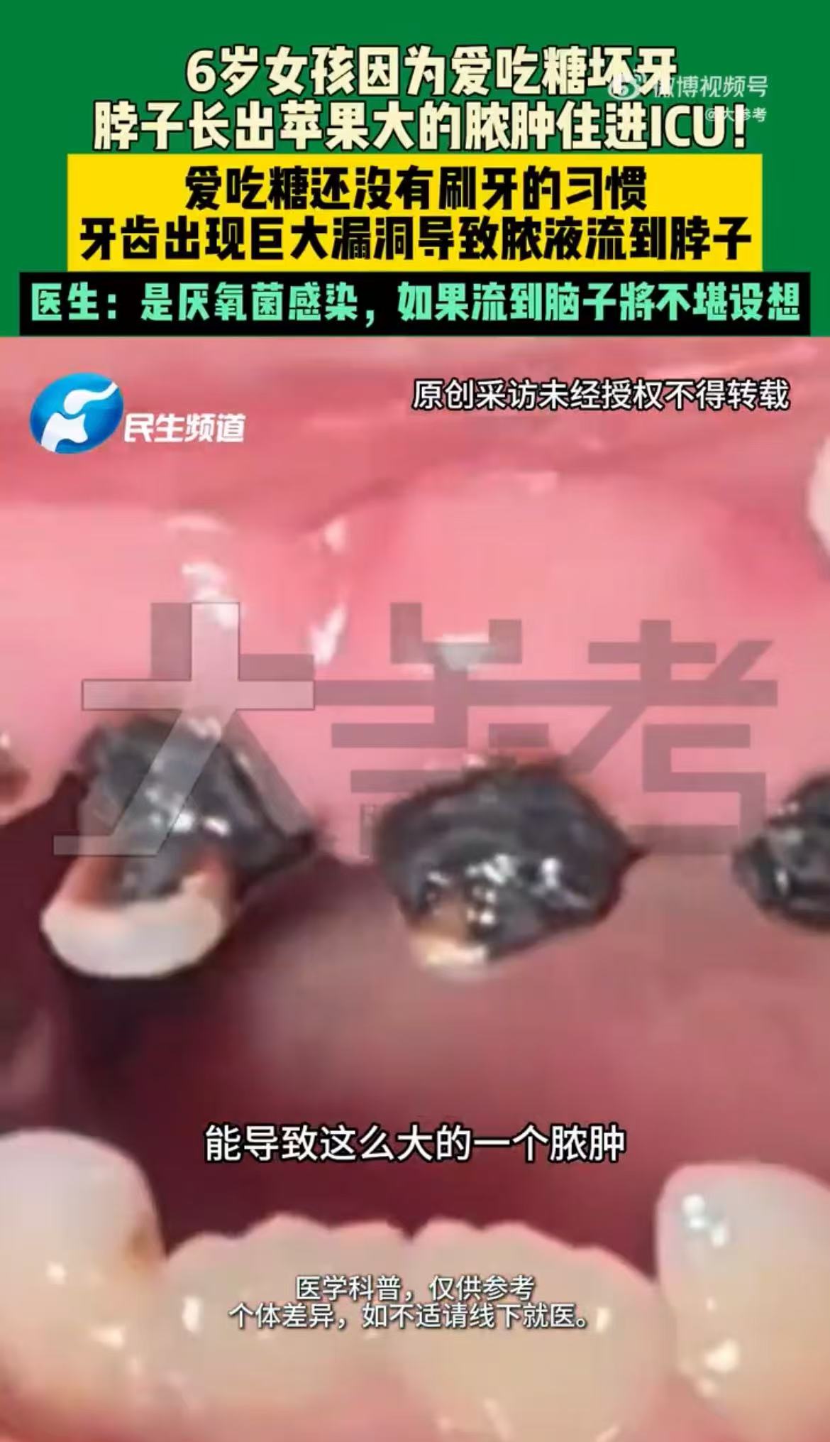 /ueditor/image/20251210/1765338017634563/09c3f9368b607f802805c93ff5c65cf1.jpg 6岁女童因蛀牙脖子长巨型脓肿进ICU 图片2.jpg